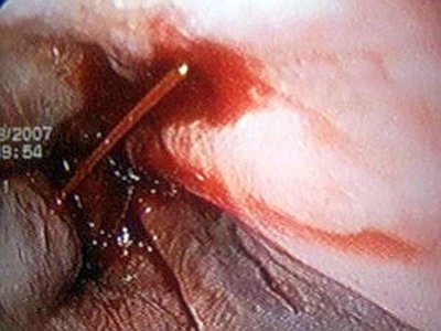 Почему болит спина в области ребер справа