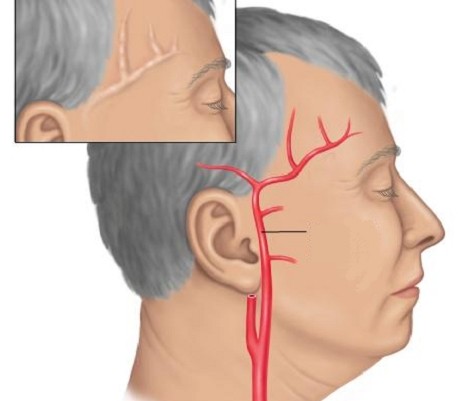 Болит голова в области виска слева и давит на глаза