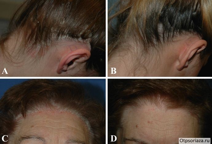 Псориаз на голове Псориаз волосистой части головы