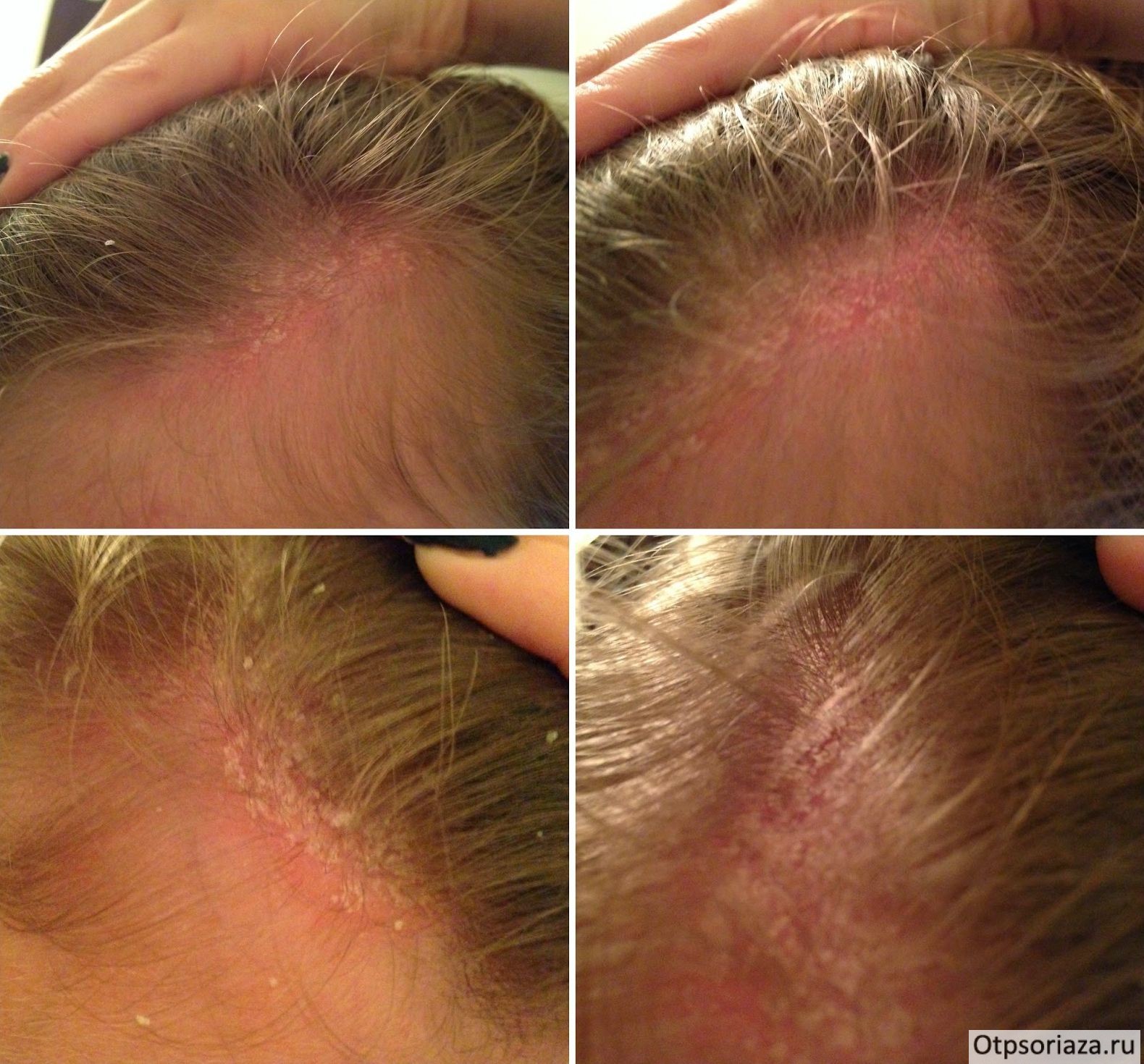 Псориаз волосистой части головы Псориаз на голове