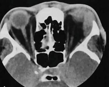 От чего болит спина и повышается температура