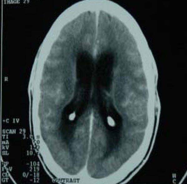 УЗИ головного мозга УЗИ мозга при ТБМ