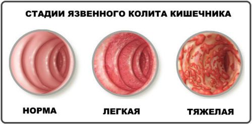 Язвенный колит