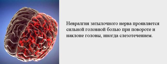 Боль при повороте головы может быть вызвана невралгией затылочного нерва Боль при повороте головы может быть вызвана невралгией затылочного нерва