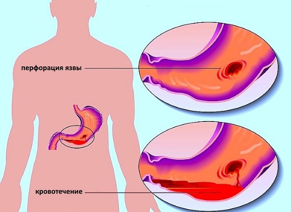 Болит спина при беге и ходьбе