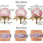 Можно ли бегать когда болит спина