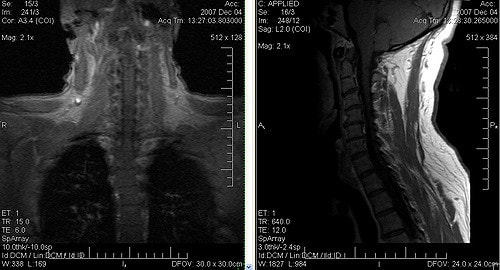 сделан в больнице шейный отдел