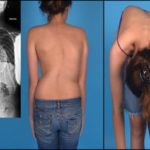 Если болит в левой части грудной клетки и отдает в спину